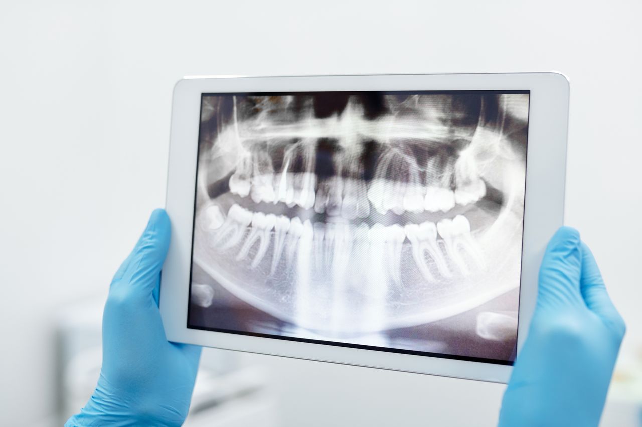 Blue-gloved hands holding a digital tablet displaying a detailed dental X-ray scan.